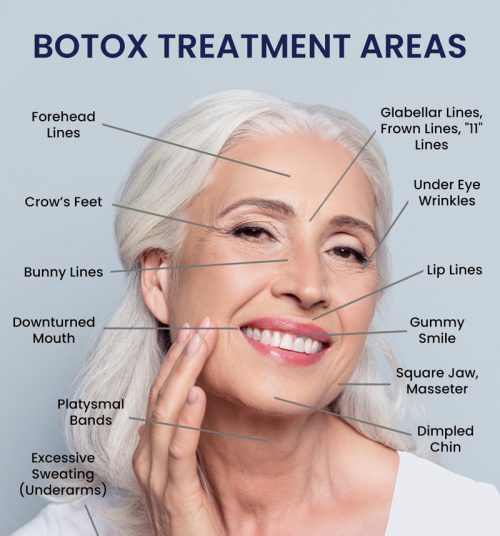 botox-treatment