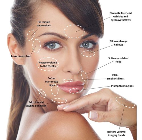 dermal-fillers